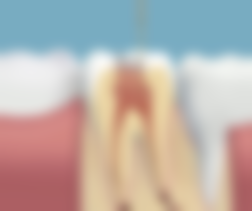 牙疼必须做根管治疗吗？在线问24h免费，后磨牙根管550起超划算！ 