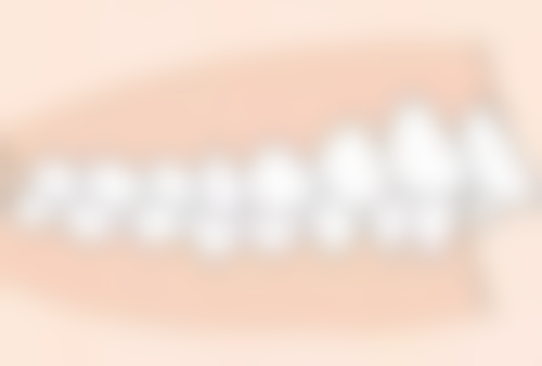 如何避免不必要地摘下烤瓷牙套