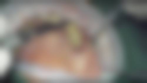 专精团队护航，半口种植难题轻松搞定