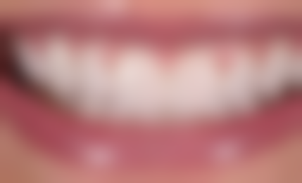 如何做牙齿的根管治疗？详细步骤、适用情况及效果解析一次了解！ 