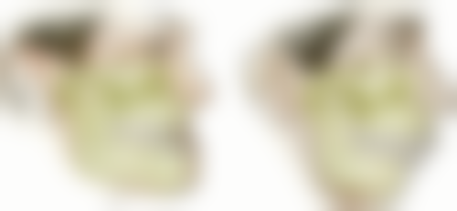 拔牙第六天还会得干槽症吗？高发期48 - 72小时，若护理不当第六天仍有风险！