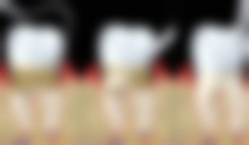 不同类型牙齿痛拔牙后疼痛特点