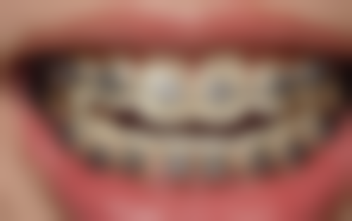 牙外伤伤及牙髓需要根管治疗