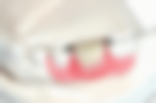 牙齿痛拔牙后还会痛吗？一般1 - 3天轻微疼痛，超5天剧痛或因干槽症等并发症 