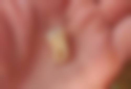 轻微地包天不能自愈的情况