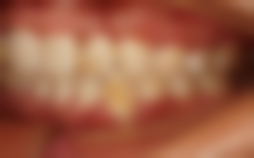 地包天整牙后脸型改变的注意事项