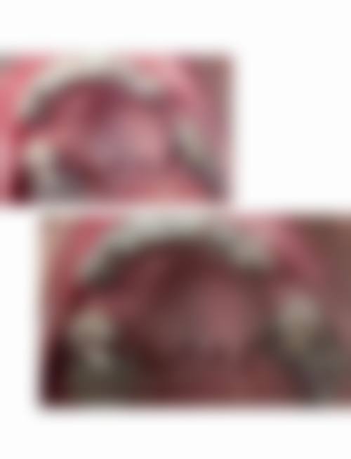 常德市第一中医医院李海波医生技术揭秘