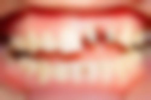 抚州市妇幼保健院口腔科：镶牙安心有保护