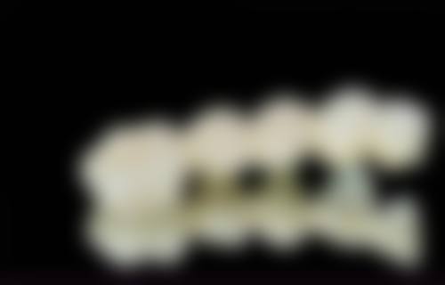 抚州英伦口腔医院：镶牙多样价目参考