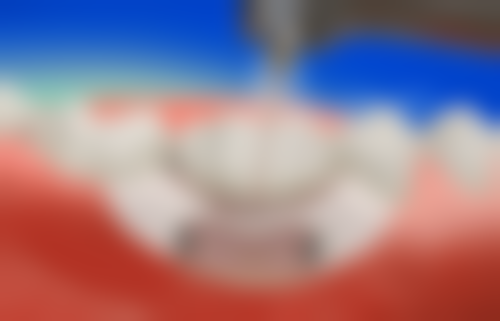 选择麦芽口腔的建议