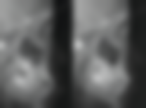 全瓷牙套做核磁共振的未来展望