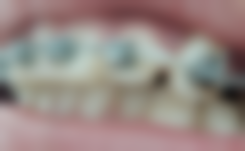 隐形义齿跟活动义齿的固位性区别