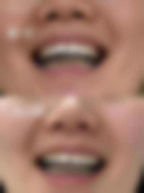 襄阳舌侧矫正收费价格:合理与差异并存