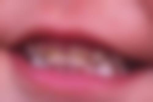 补牙次数与特殊情况