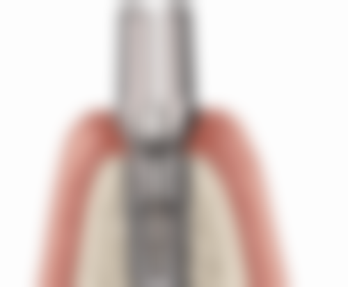 成人地包天矫正的成效与反弹问题