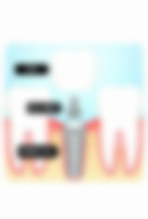 常熟种植牙价格参考:心中有数,理性选择