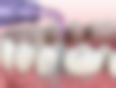 成人地包天矫正的注意事项