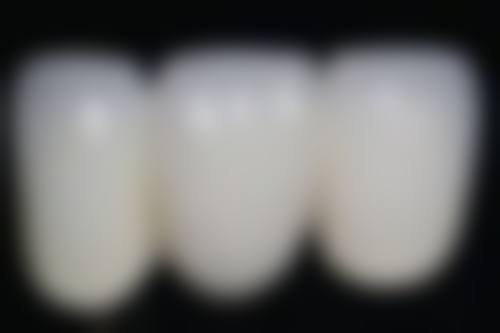 根管治疗的益处及注意事项