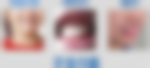 根管治疗填牙单次填充时间