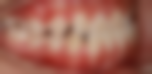 全瓷牙使用中出现出血症状时需要更换