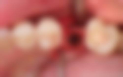 超详细！广大口腔种植牙收费价格大公开