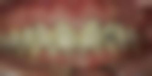 河北牙齿修复医院在线咨询24小时，镶一颗牙300 - 5000元，全口活动假牙1000 - 40000元超实惠！ 