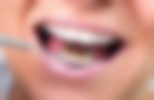 泽康全瓷牙的亮点