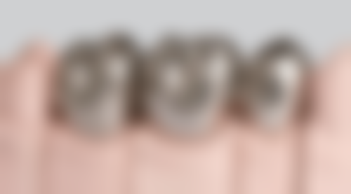 门牙根管治疗后做牙冠的实例分析