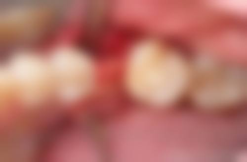 {广州南沙诚飞口腔进口种植体价格低至510元起：还有3980元全包仕诺康、半口4万、全口8万种植方案 