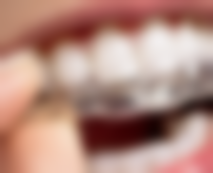 补牙后多久能吃东西？视材料而定，短则30分钟长则24小时，初期忌硬粘热食