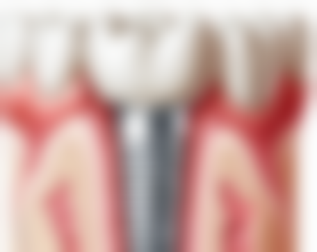 洗牙粉与其他清洁方式对比