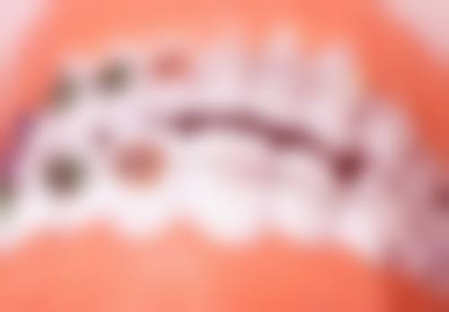 洗牙有好处吗会不会破坏牙齿？正规操作无损伤，还能清除牙结石、预防牙周炎症