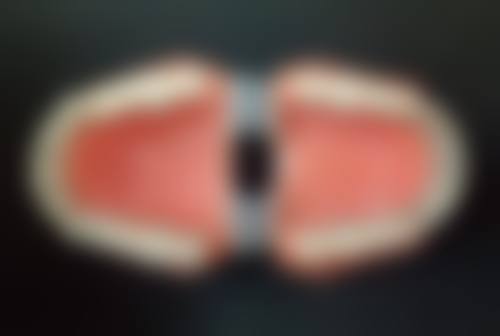 拔牙后隐形矫正的时间选择