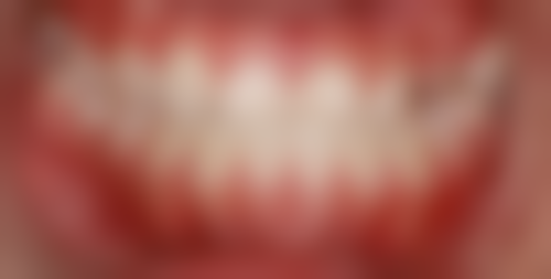 中端种植牙品牌推荐