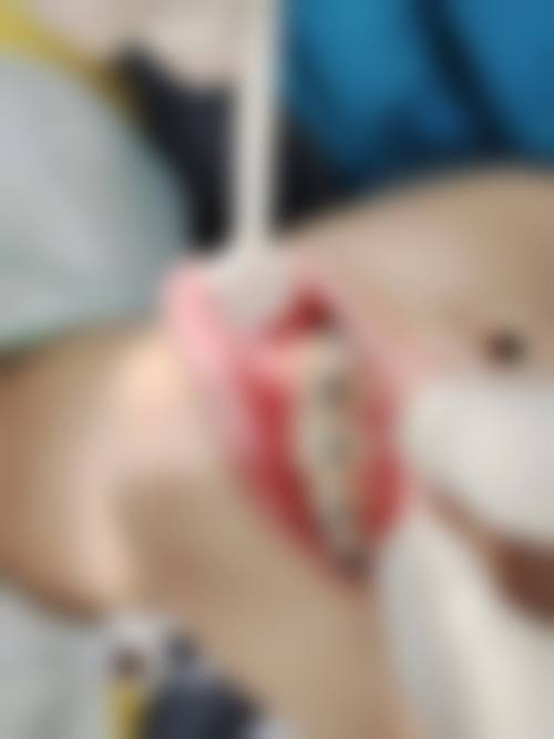 宿迁金属矫正24小时在线咨询：靠谱！雅乐、钟吾、金铂利口腔可选，金属托槽矫正4000 - 8000元 