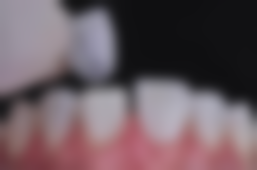 秋季拔牙种植牙的好处