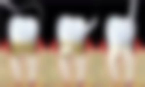 重度地包天矫正的方法及实例