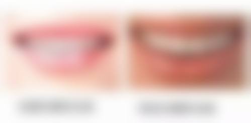 乌鲁木齐金属矫正24小时在线咨询：美奥、洪志、优佳贝口腔任你选，金属矫正低至5280元起！ 