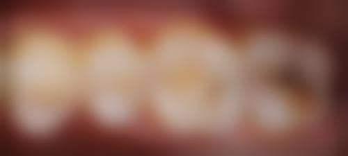 宿州市立医院高宇医生补牙优势