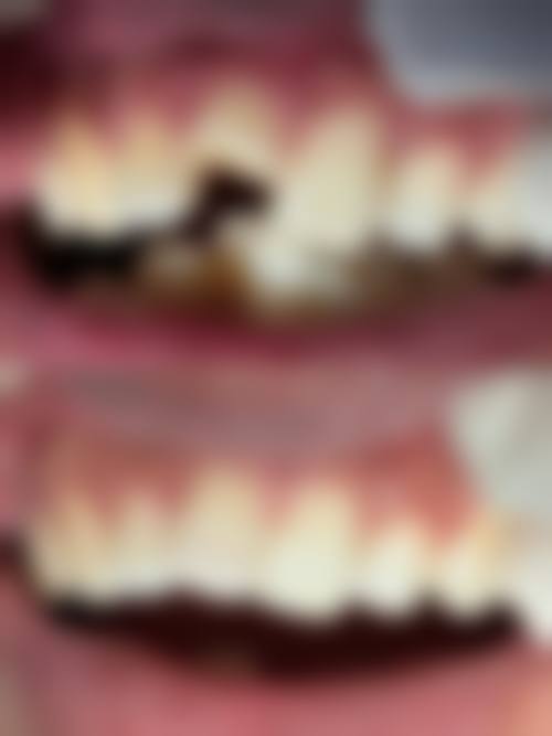 种牙选择：多因素考量定方案