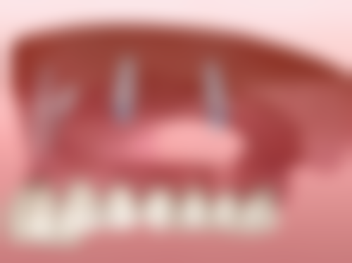 烤瓷牙吃瓜子的替代选择