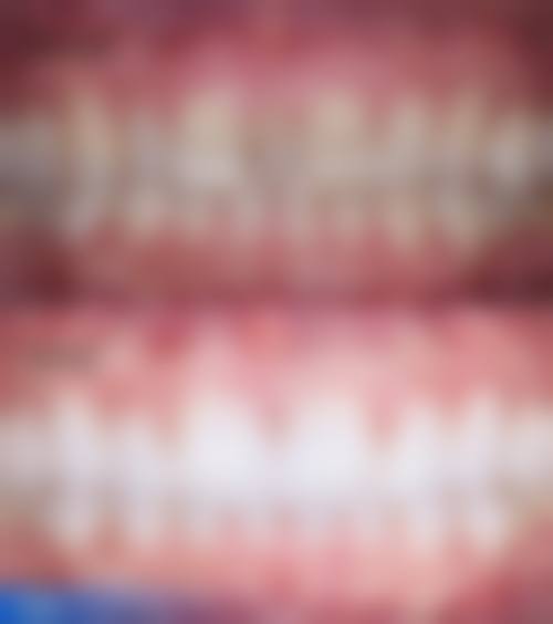 郑州镶假牙医院24小时在线咨询：烤瓷牙400元起、全瓷牙1200元起，多种镶牙方式任你选！ 