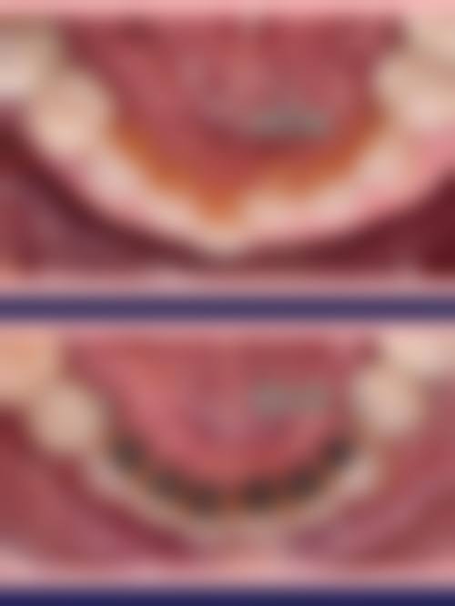 嘉善金铂利口腔舌侧矫正情况