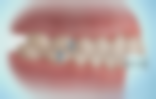 皓得适牙齿美白和皓齿美白的成效呈现对比