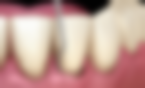 全瓷牙冠的试戴过程