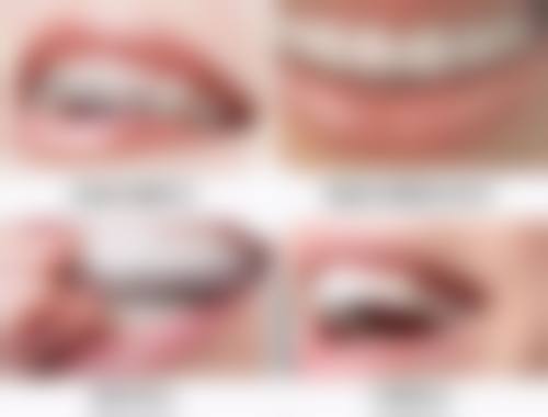 牙齿有牙结石洗牙的不同方式及特点