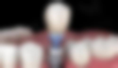 铜陵柏年口腔：技术精良省36%，半口种植新选择