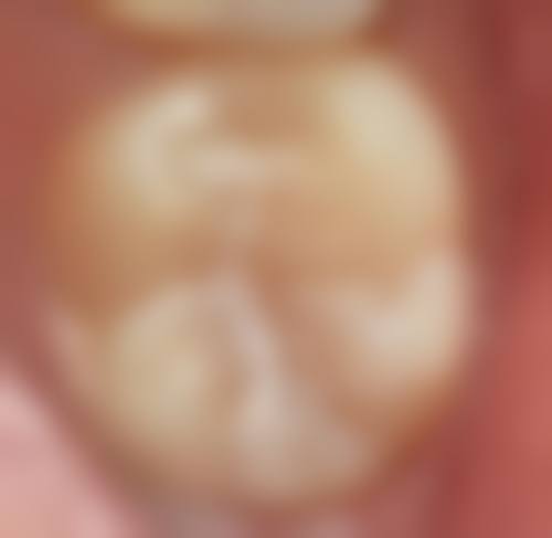 阿克苏拔牙24小时在线咨询：苏和口腔0997 - 2121280随时答疑，拔牙100元起！ 