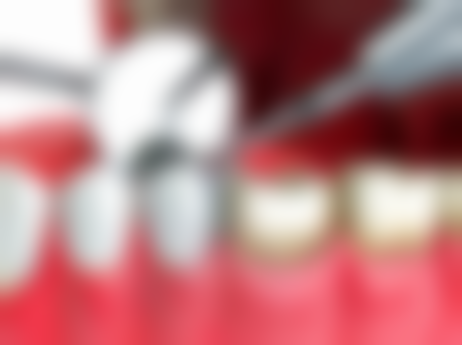 合理洗牙频率的重要性