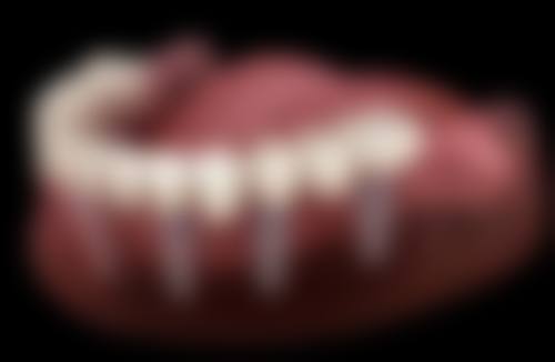 2026年选择种植牙的避坑提醒